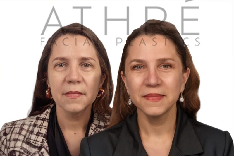 Female patient after 4D Facelift™, deep neck lift, and facial fat transfer by Dr. Raghu Athré.