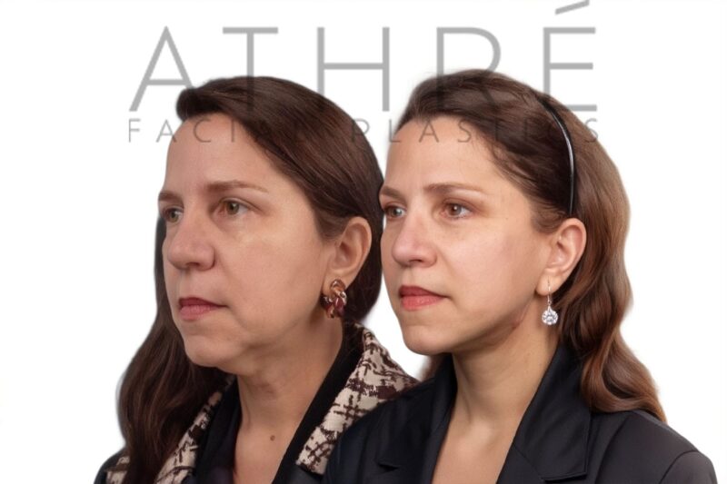 Before and after facial rejuvenation with facelift and lower eyelid surgery by Dr. Raghu Athré.