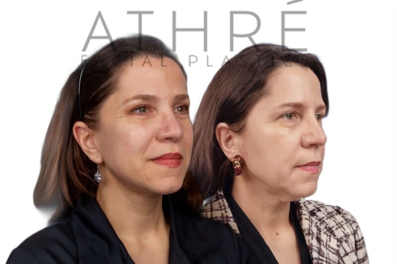 Female patient shown after stem cell nanofat treatment and neck lift performed by Dr. Raghu Athré.