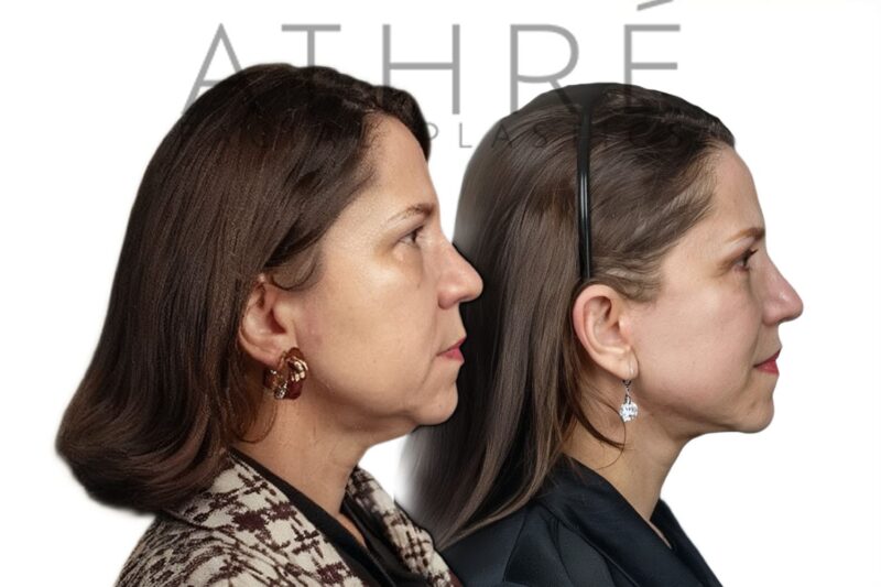 Facial rejuvenation surgery including facelift and autologous fat transfer performed by Dr. Raghu Athré.