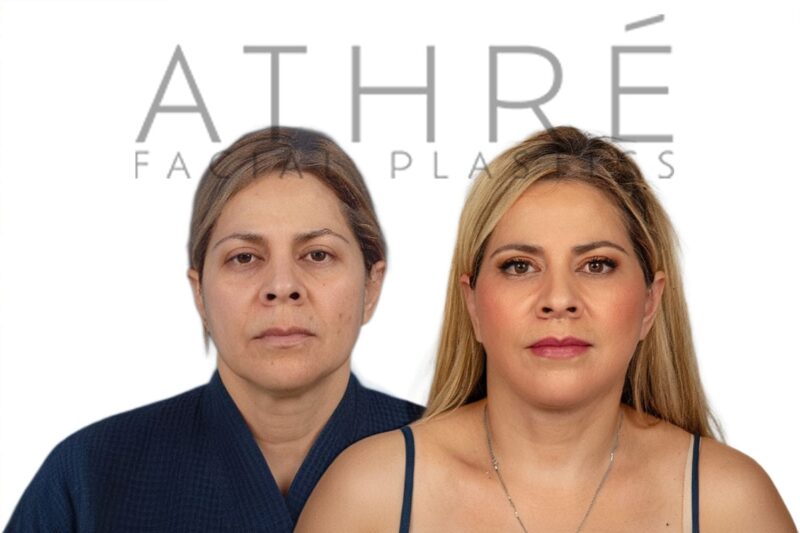 Before and after deep plane facelift, brow lift, and lip lift by Dr. Raghu Athré in female patient.