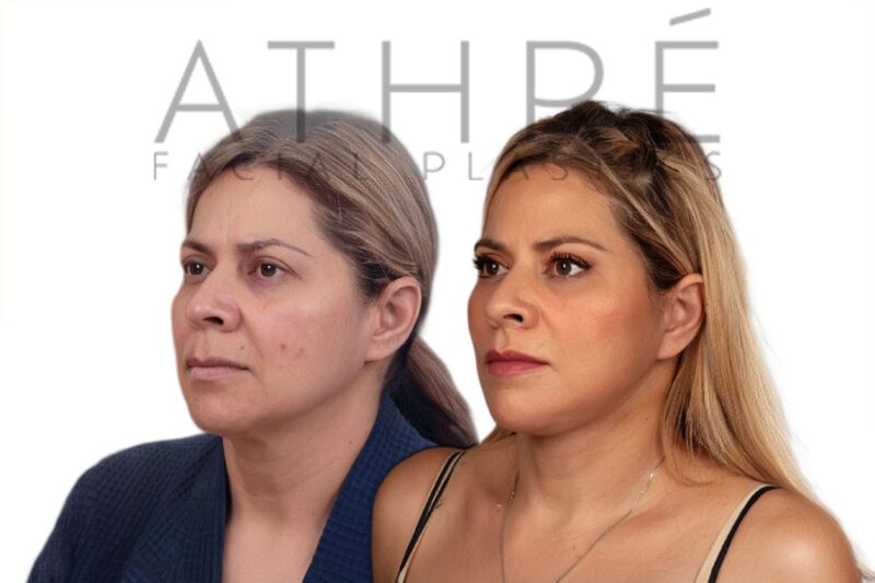 Female patient after 4D Facelift™, deep neck lift, and facial fat transfer by Dr. Raghu Athré.