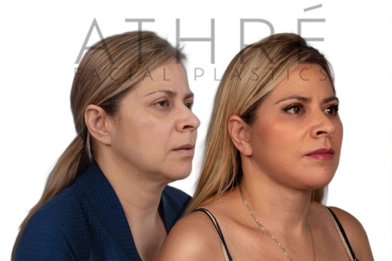 Before and after facial rejuvenation with facelift and stem cell nanofat treatment by Dr. Raghu Athré.