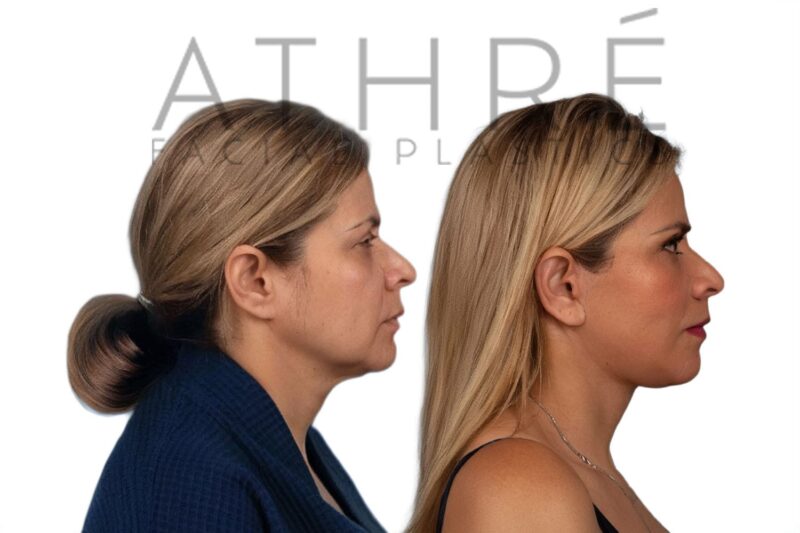 Female patient shown after brow lift and neck rejuvenation surgery performed by Dr. Raghu Athré.