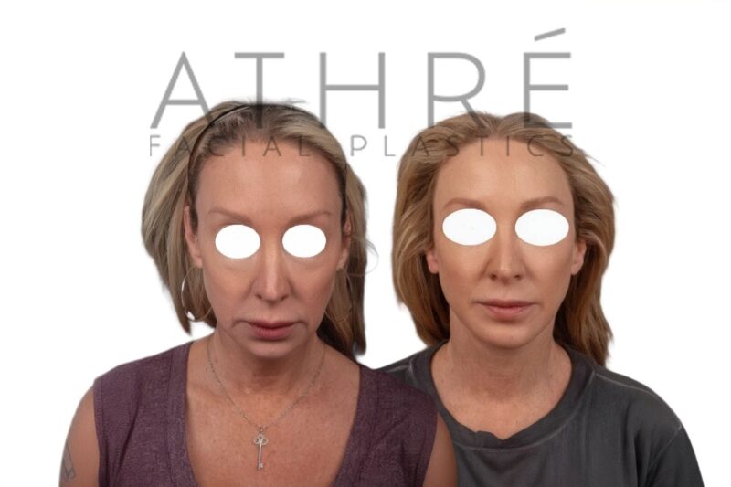 Before and after deep plane facelift and neck lift by Dr. Raghu Athré in female patient.