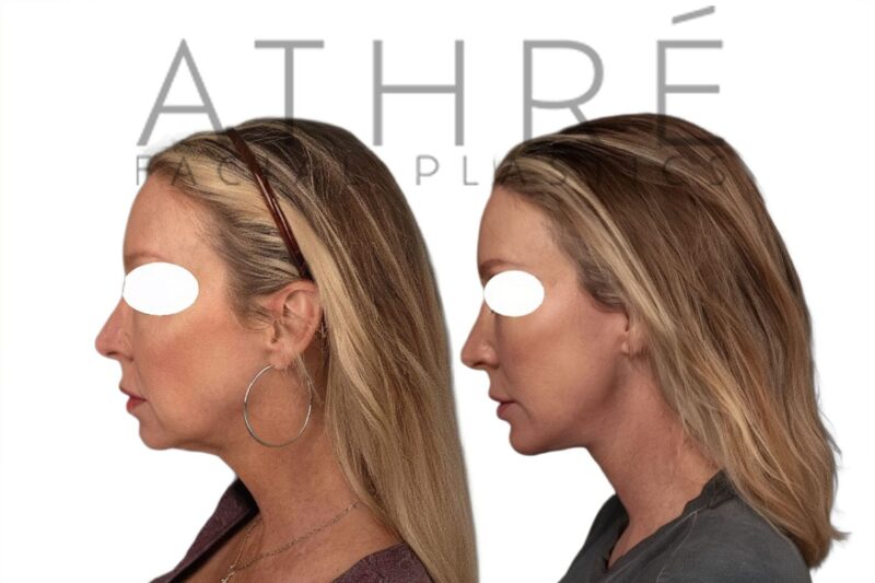 Female patient after 4D Facelift™, facial fat transfer, and lip augmentation with fat by Dr. Raghu Athré.