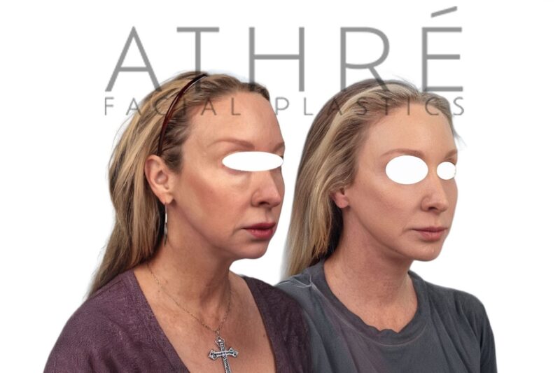 Before and after facial rejuvenation with deep neck lift and stem cell nanofat treatment by Dr. Raghu Athré.
