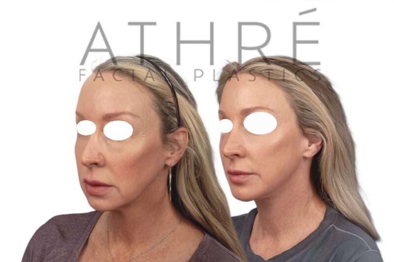 Female patient shown after facelift, fat grafting, and lip enhancement performed by Dr. Raghu Athré.