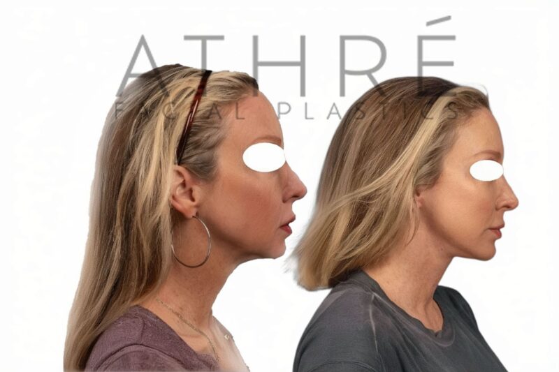 Facial rejuvenation surgery including facelift and facial fat transfer by Dr. Raghu Athré.
