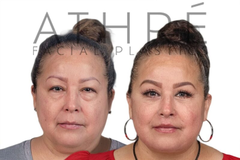 Before and after deep plane facelift and blepharoplasty by Dr. Raghu Athré in female patient.