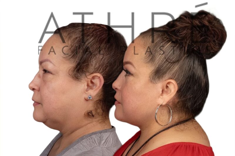 Female patient after 4D Facelift™, upper and lower eyelid surgery, and neck lift by Dr. Raghu Athré.