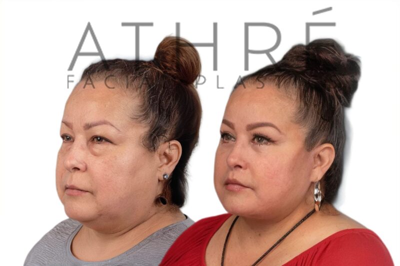 Before and after facial rejuvenation with facelift and lip lift by Dr. Raghu Athré.