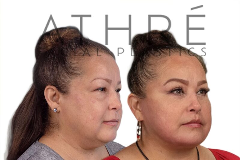 Female patient shown after deep neck lift and stem cell nanofat lip augmentation by Dr. Raghu Athré.