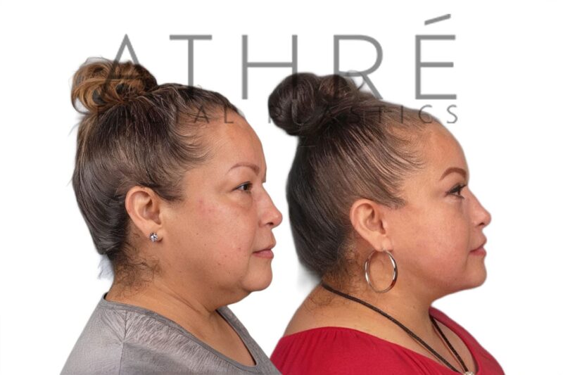 Facial rejuvenation surgery including facelift and blepharoplasty performed by Dr. Raghu Athré.