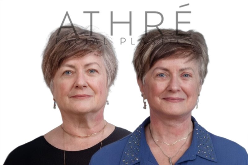 Before and after deep plane facelift and upper blepharoplasty by Dr. Raghu Athré in female patient.