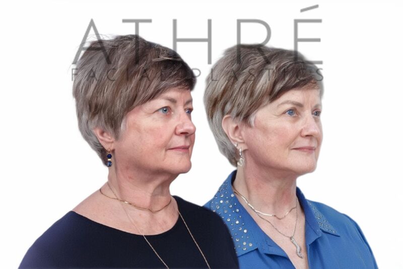 Female patient after 4D Facelift™, lower eyelid skin pinch, and facial fat transfer by Dr. Raghu Athré.