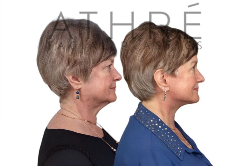 Before and after facial rejuvenation with deep neck lift and lip augmentation by Dr. Raghu Athré.