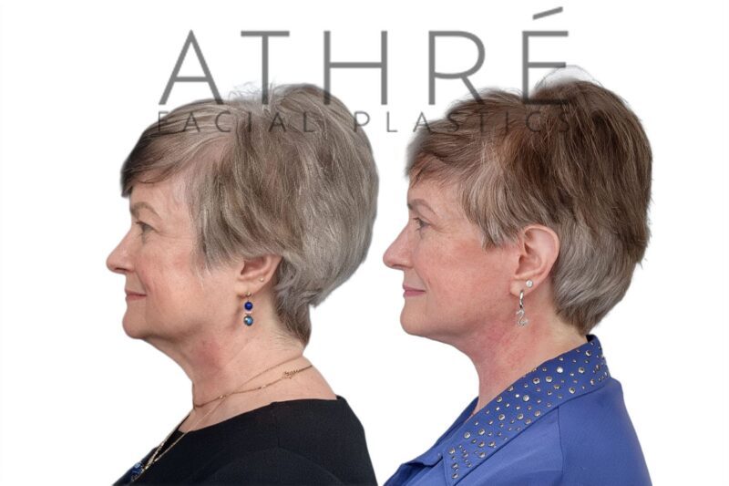 Facial rejuvenation surgery including facelift and eyelid surgery performed by Dr. Raghu Athré.