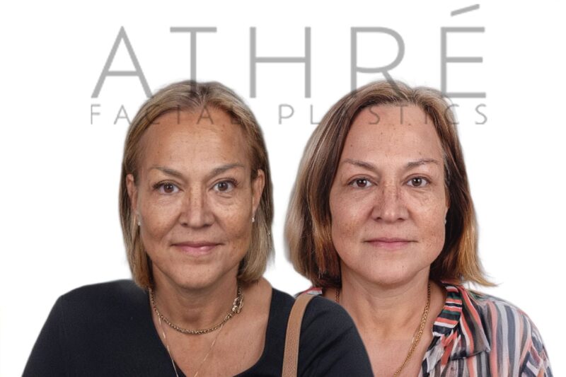 Before and after deep plane facelift and upper blepharoplasty by Dr. Raghu Athré in female patient.