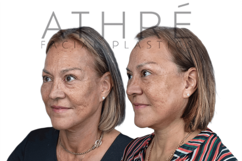 Female patient after 4D Facelift™, facial fat transfer, and deep neck lift by Dr. Raghu Athré.
