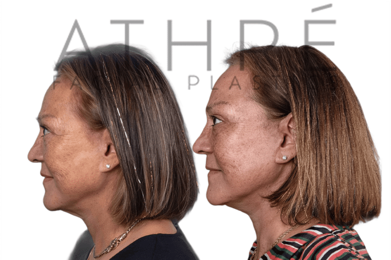 Before and after facial rejuvenation with facelift and stem cell nanofat treatment by Dr. Raghu Athré.