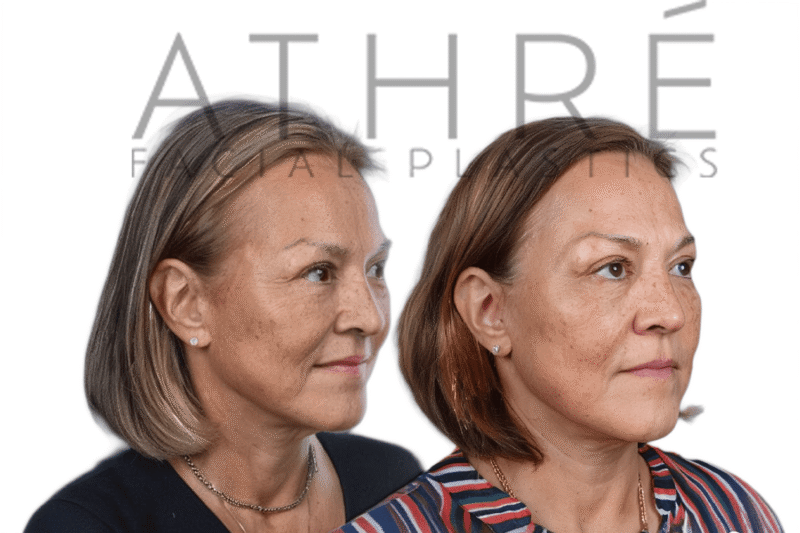 Female patient shown after upper eyelid surgery and facial fat grafting performed by Dr. Raghu Athré.