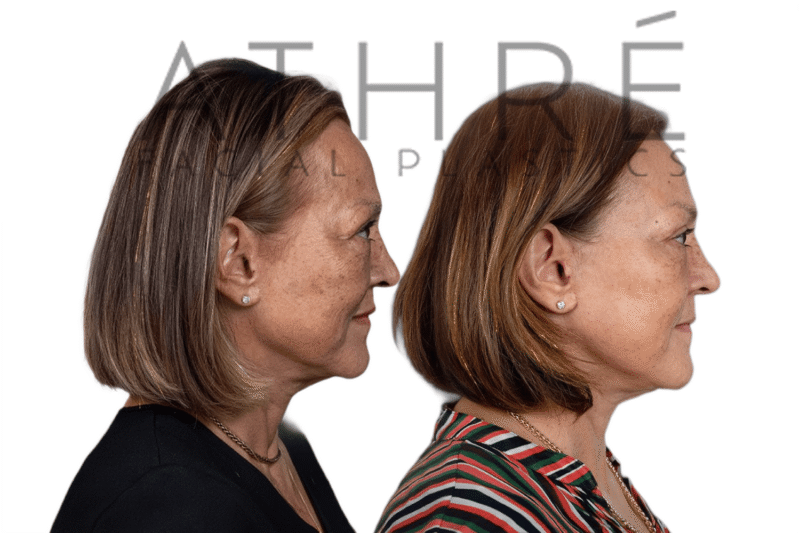 Facial rejuvenation surgery including facelift and blepharoplasty performed by Dr. Raghu Athré.