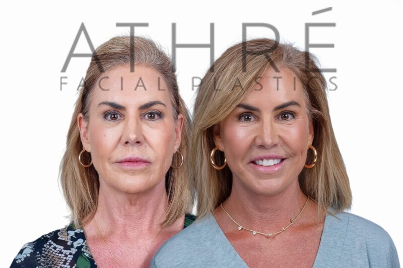 Female patient before and after 4D Facelift and facial resurfacing by Dr. Raghu Athré.