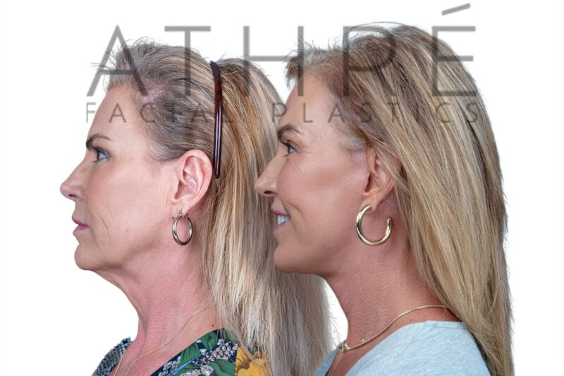 Before and after comprehensive facial rejuvenation surgery by Dr. Raghu Athré.