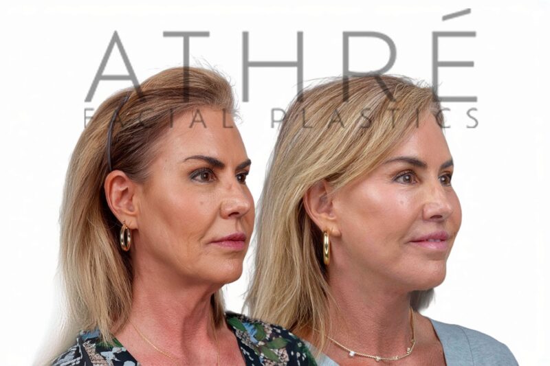 Before and after facial rejuvenation with deep neck lift by Dr. Raghu Athré.