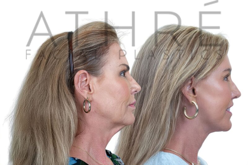 Female patient before and after deep plane facelift and lip lift by Dr. Raghu Athré