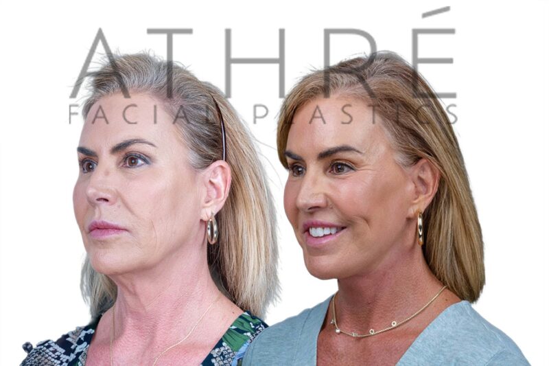 Before and after 4D Facelift and upper blepharoplasty by Dr. Raghu Athré