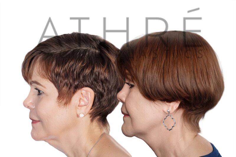 Before and after revision deep plane facelift and neck lift by Dr. Raghu Athré in 71-year-old female patient.