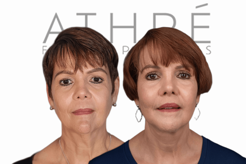 Female patient after Revision 4D Facelift™, upper blepharoplasty, and facial fat transfer by Dr. Raghu Athré.