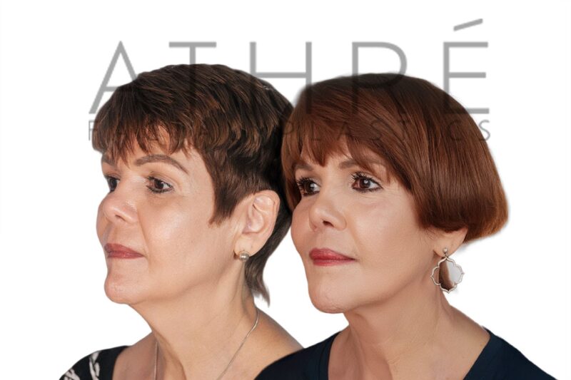 Before and after facial rejuvenation with revision facelift and CO2 laser resurfacing by Dr. Raghu Athré.