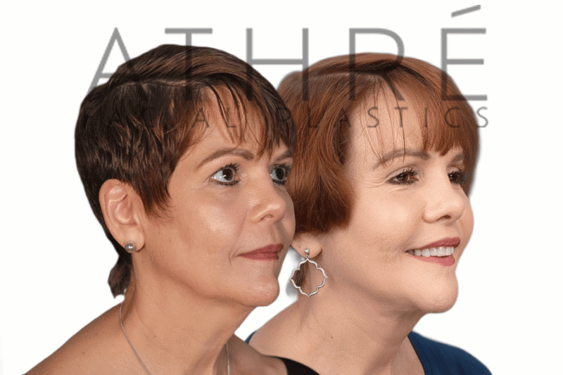 71-year-old female patient shown after deep neck lift and nanofat stem cell treatment by Dr. Raghu Athré.
