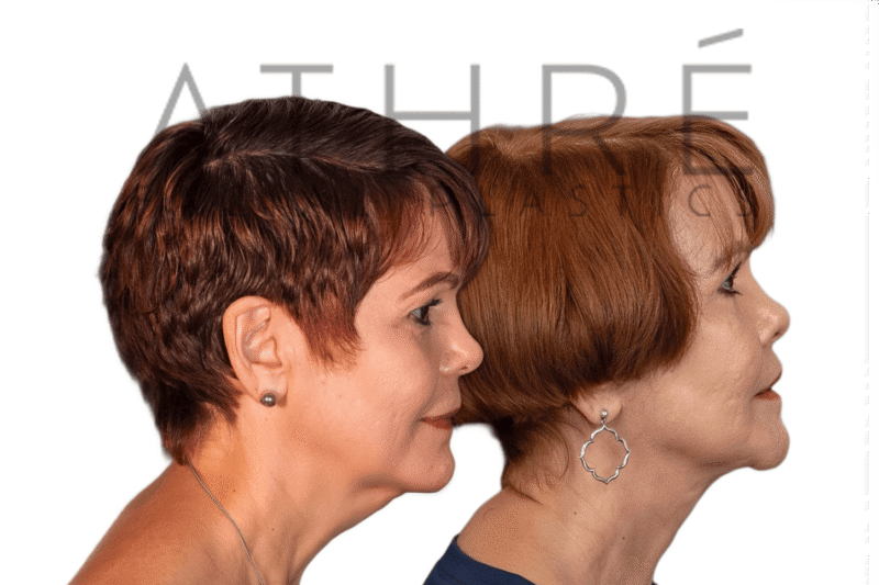 Revision facelift and facial rejuvenation surgery performed by Dr. Raghu Athré.