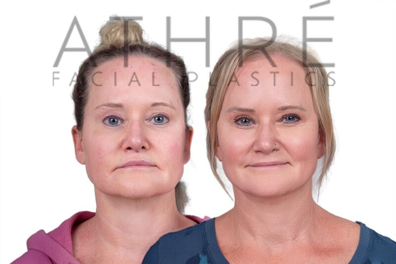 Before and after SMAS facelift and neck lift by Dr. Raghu Athré in female patient.