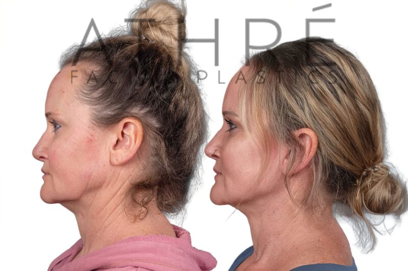 Female patient after facelift, neck lift, and facial fat transfer by Dr. Raghu Athré.