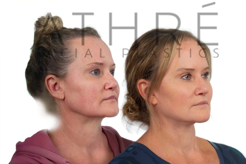 Before and after facial rejuvenation with SMAS facelift by Dr. Raghu Athré.