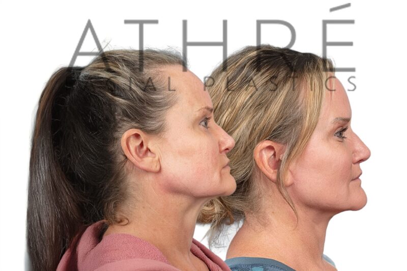 Female patient shown after neck lift and facial fat grafting performed by Dr. Raghu Athré.