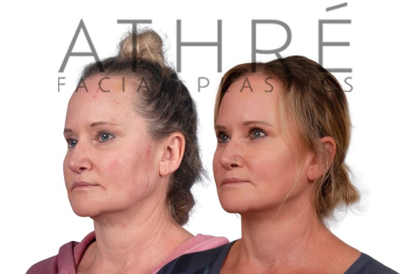 Facial rejuvenation surgery including SMAS facelift and neck lift by Dr. Raghu Athré.