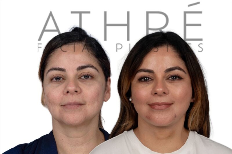 Before and after deep plane facelift and neck lift by Dr. Raghu Athré in 46-year-old female patient.