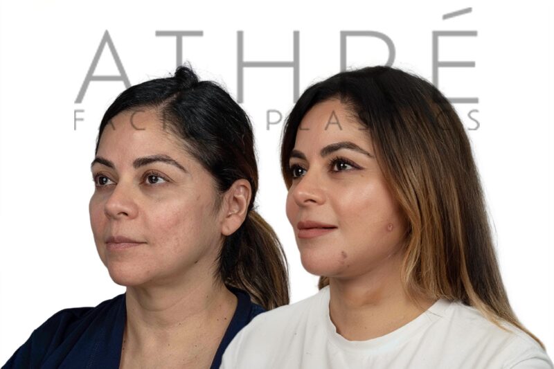Female patient after 4D Facelift™, facial fat transfer, and stem cell treatment by Dr. Raghu Athré.