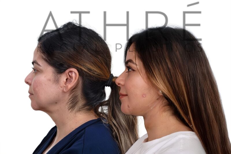 Before and after facial rejuvenation with deep plane facelift by Dr. Raghu Athré.