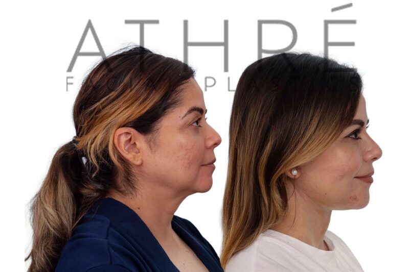 46-year-old woman shown after deep neck lift and facial fat grafting performed by Dr. Raghu Athré.