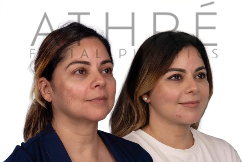 Facial rejuvenation surgery including facelift and stem cell treatment performed by Dr. Raghu Athré.