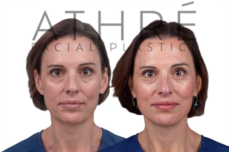 Before and after deep plane facelift, brow lift, and neck lift by Dr. Raghu Athré in 50-year-old female patient.