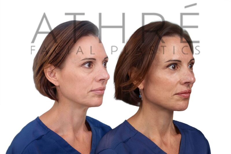 Female patient after 4D Facelift™, facial fat transfer, and brow lift by Dr. Raghu Athré.