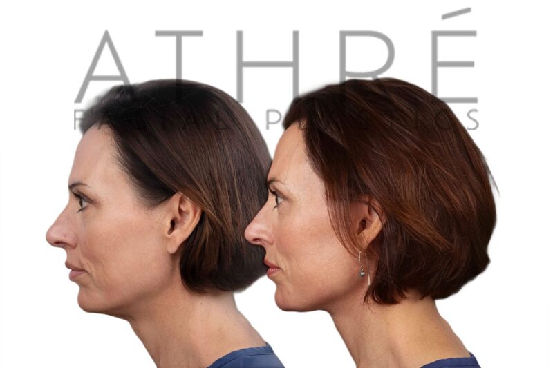 Before and after facial rejuvenation with deep plane facelift and neck lift by Dr. Raghu Athré.